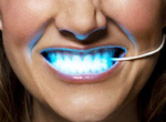 Безопасное и выгодное отбеливание зубов